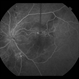 Hypertensive Retinopathy Hypertensive Retinopathy